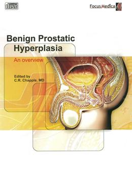 Benign prostatic hyperplasia an overview 良性前列腺肥大