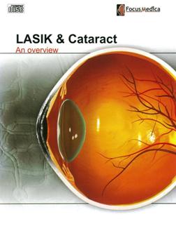 LASIK & cataract an overview 雷射近視手術與白內障