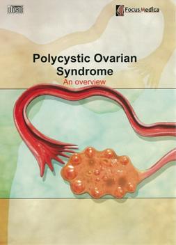 Polycystic ovarian syndrome an overview 多囊性卵巢症候群