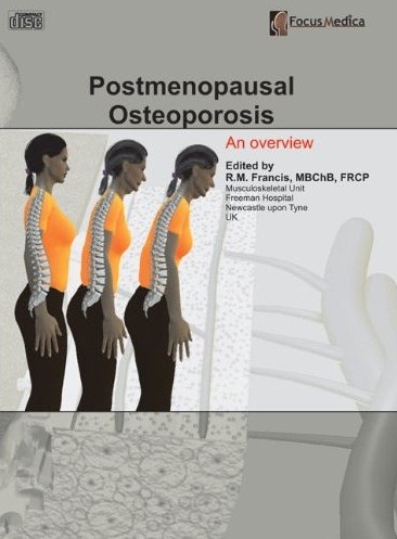 Postmenopausal osteoporosis 更年期後之骨質疏鬆症 an overview