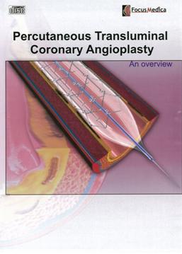 Percutaneous transluminal coronary angioplasty  心冠狀動脈氣球擴張術 an overview