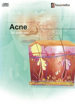 Acne an overview